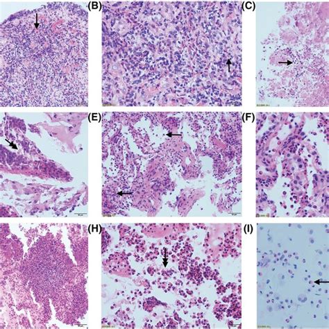 Pathology of bronchoscopic biopsy and pulmonary biopsy of chronic... | Download Scientific Diagram