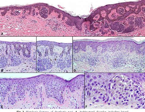 Figure 2 from The dysplastic nevus: from historical perspective to management in the modern era ...