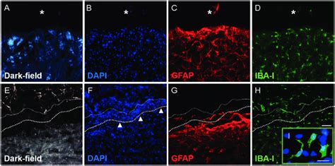 Immunohistochemistry for GFAP and IBA-I revealing the tissue interface ...