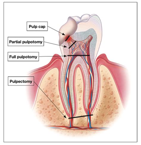 Traumatic Pulp Exposures: An Exposé - Dentistry Today