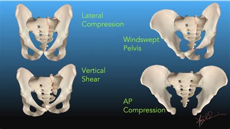 Pelvic Fractures | UW Emergency Radiology