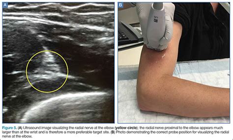 Emergency Ultrasound: Ultrasound-Guided Ulnar, Median, and Radial Nerve ...