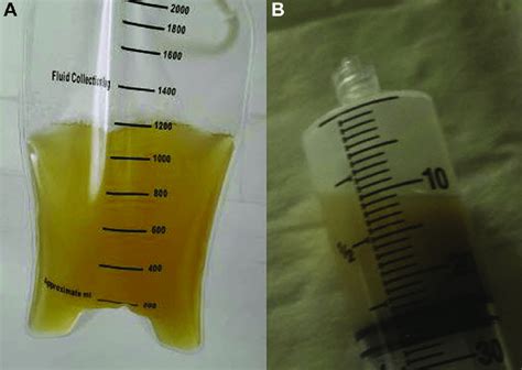 -A, Straw yellow transparent pleural fluid on initial thoracentesis on... | Download Scientific ...