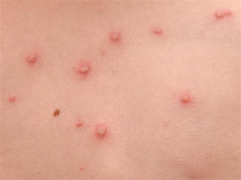 The chicken pox vaccine | BabyCenter