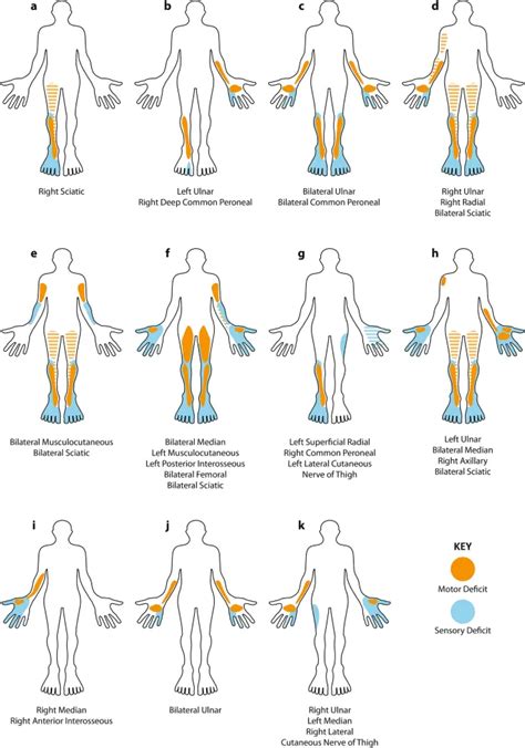 Mononeuritis Multiplex - Causes, Symptoms, and Treatment