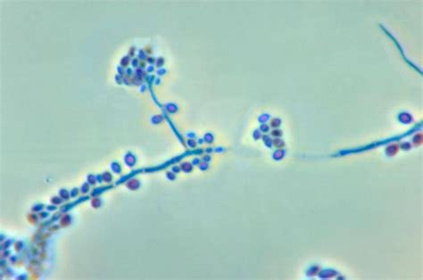 Sporotrichosis (Sporothrix Fungal Infection) Information and Pictures ...