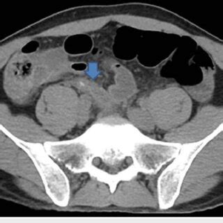 Axial, non-contrast CT scan showing acute appendicitis. Blue arrow ...