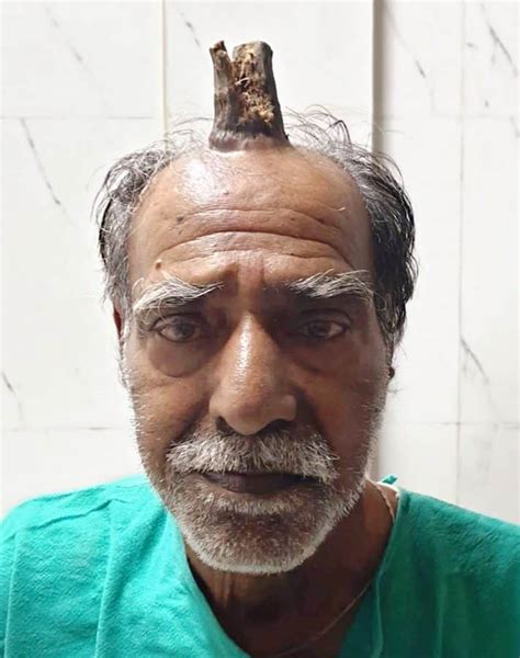 Indian Man Grows Four-Inch Horn After Head Injury (Graphic Photo) - Health (2) - Nigeria