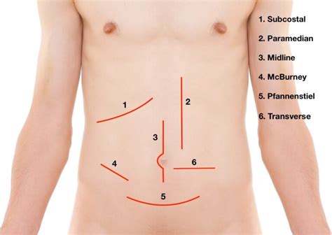 Abdominal Incisions | Medical Junction