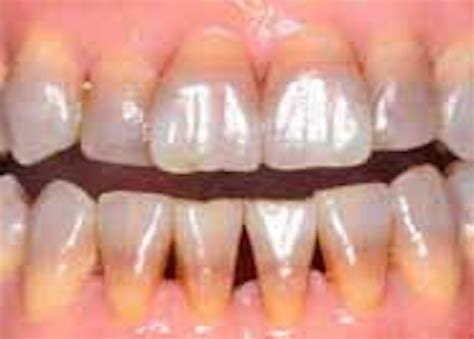 Teeth staining summary by color and origin for the dental hygiene exams | DentistryIQ