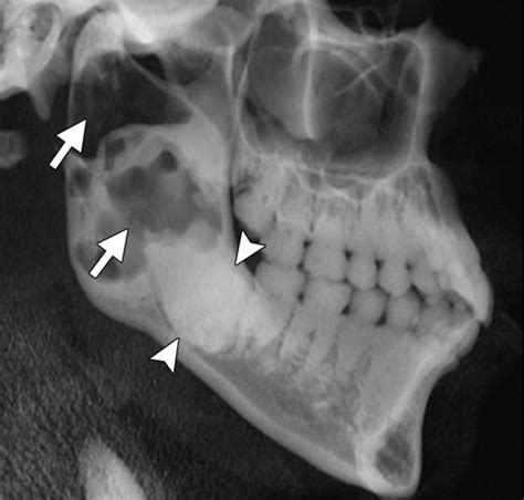 Radiopaque Jaw Lesions: An Approach to the Differential Diagnosis | RadioGraphics