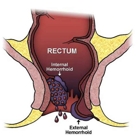 What are the symptoms and natural cure of hemorrhoids? - OFW Buddy