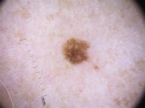 Atypical Nevus | Pennsylvania Dermatology Specialists