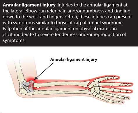 Elbow Pain - Ulnar Collateral Ligament Sprain - GetProlo.com