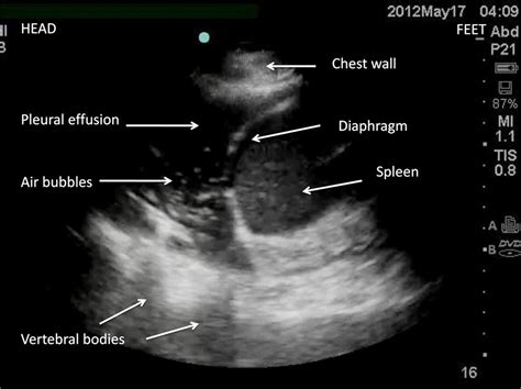 Ascites Vs Pleural Effusion Ultrasound