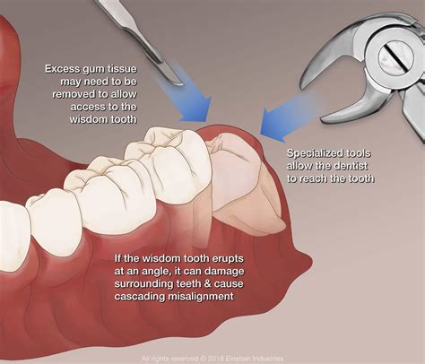 Wisdom Teeth Removal Specialist - Washington, DC: K Street Dental & Orthodontic Group: Cosmetic ...