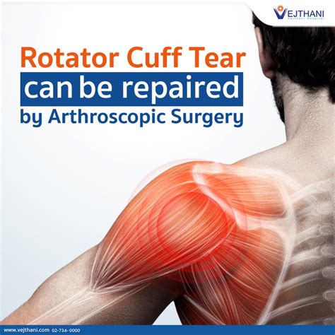 Rotator Cuff Tear can be repaired by Arthroscopic Surgery - Vejthani Hospital