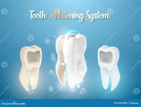 3D Realistic Vector Teeth Cleaning Process. Healthcare Stomatology ...