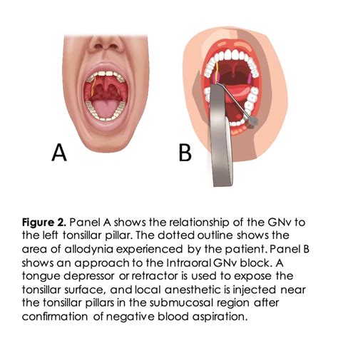 Glossopharyngeal Nerve Palsy