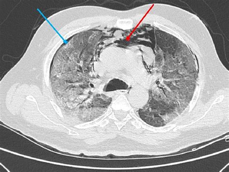 COVID-19-Associated Pneumomediastinum and Pneumothorax: A Case Series | Cureus