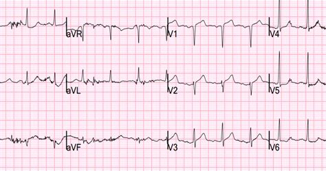 Dr. Smith's ECG Blog: Septal STEMI with lateral ST depression, then has ...