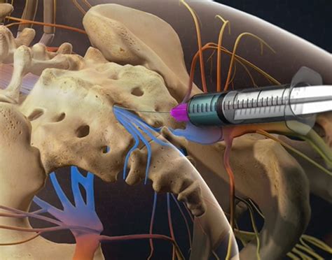 Caudal Epidural Steroid Injection | Treatments | Twin Cities Pain Clinic