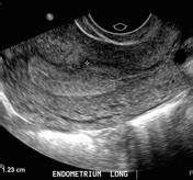 Endometrial thickness | Radiology Reference Article | Radiopaedia.org