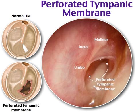 Perforated Tympanic Membrane | Medical surgical nursing, Pediatric nurse practitioner, Pediatric ...