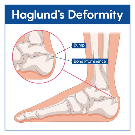 Haglund’s Deformity Causes & Treatment – My FootDr