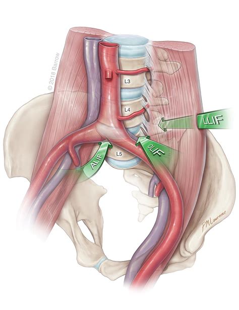 What is ALIF Surgery? | Barrow Neurological Institute