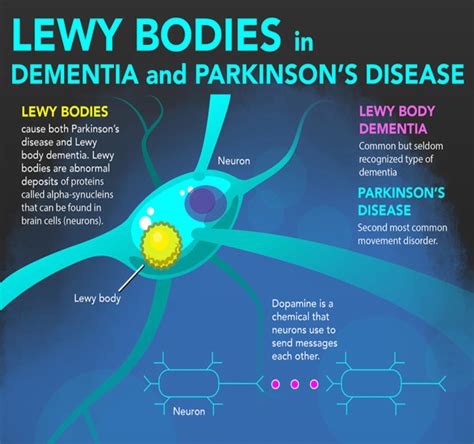 "Lewy Bodies in Dementia and Parkinson's Disease" Infographic (NIH) - Brain Support Network