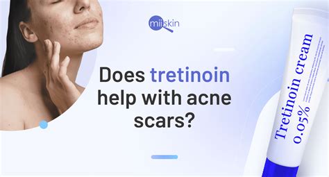 Tretinoin vs. retinol: Is tretinoin really much better?