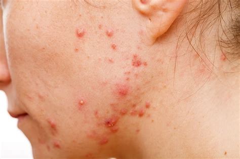 What Causes Acne Pustules? How to Get Rid of Them? – Derma Drink