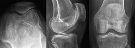 NYC Torn Meniscus Symptoms, Surgery, Treatment | Knee Orthopedics UES