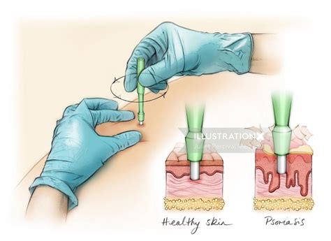 Punch Biopsy | Illustration by Juliet Percival Medical