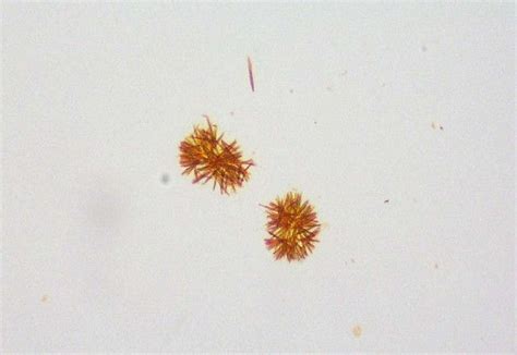 Bilirubin-crystals-in-urine | Medical laboratory science | Medical laboratory science, Medical ...