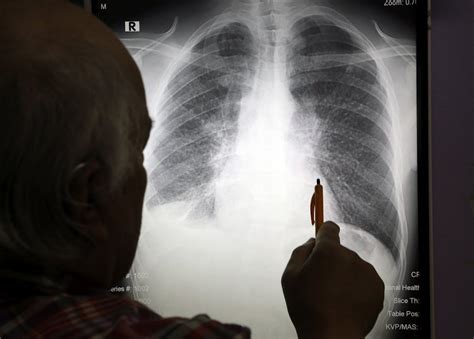 Silicosis’s toxic legacy offers deadly lessons for today