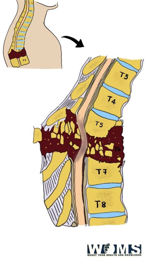 Vertebral Fracture - WOMS