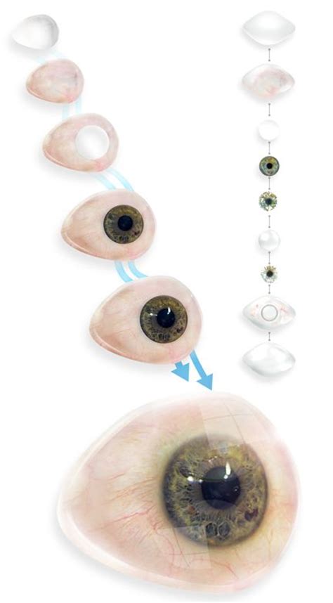 Prosthetic Eye Clinic / Ocular Prosthesis Technologies | Prosthetic eye ...