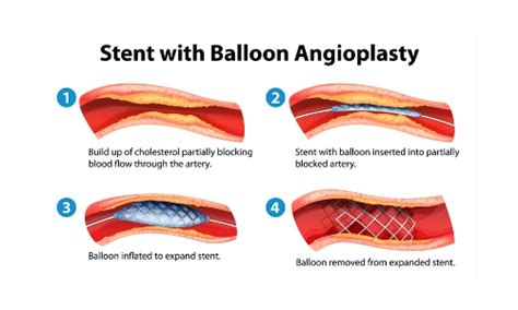 Wichita Surgical Specialists | Vascular Surgery | Stroke | Carotid Arteries