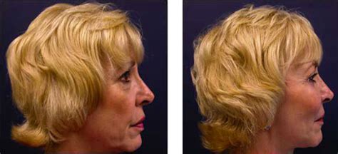 Facelift Before and After 40 Year Old | Lifestyle Lift