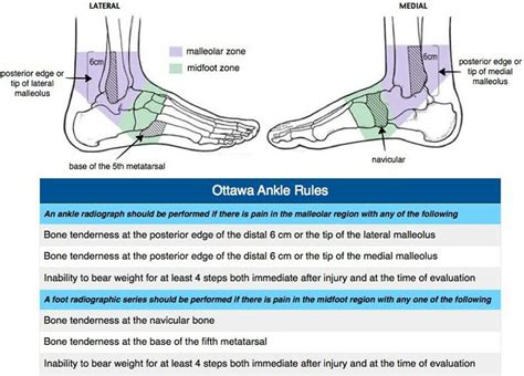 Ottawa Ankle Rules | Nursing information, Medical training, Medical ...