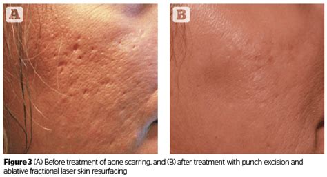 The treatment of acne scars | PRIME Journal