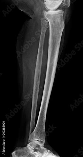 "Lower leg xray , x-ray image of leg side / latteral view , xray of normal leg bone in adult ...