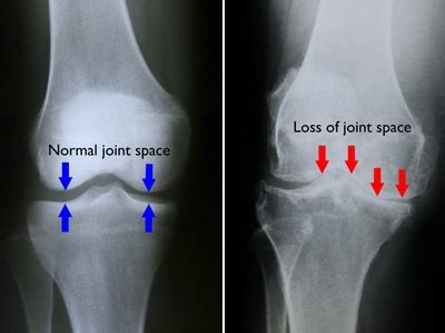 Knee Osteoarthritis - An Overview - Robert Howells