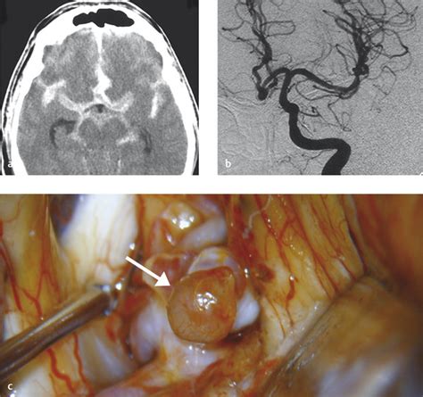 4 Intracranial Aneurysms | Radiology Key