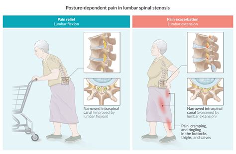 Lumbar Spinal Stenosis Cauda Equina Syndrome Sciatica