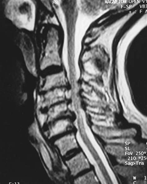 Spinal Cord Compression Causes, Symptoms, Diagnosis and Treatment