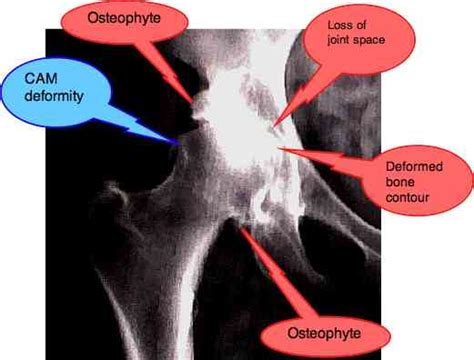 Kellgren Lawrence grading scale gives a x-ray rating of hip arthritis.