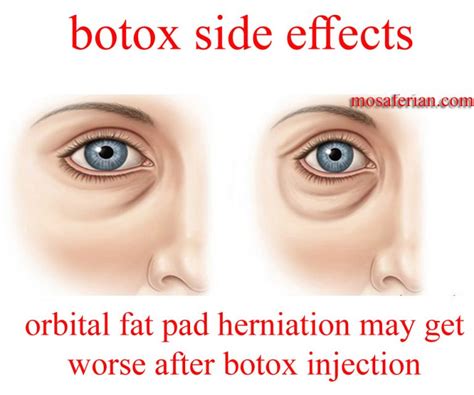botox side effects include: Pain, swelling or bruising at the injection site